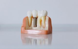 implantes dentales en caracas